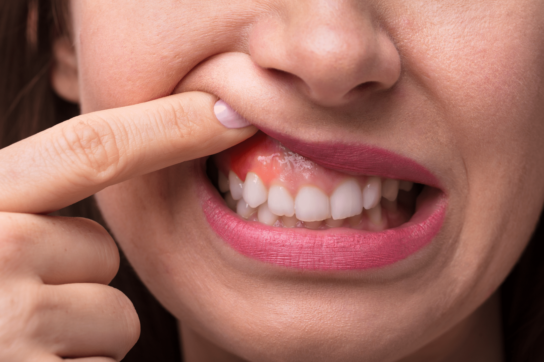 Advanced Gum Treatment